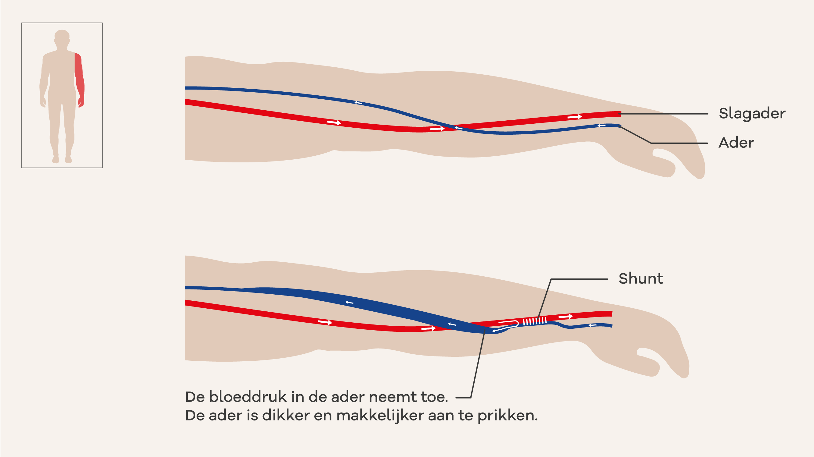 Illustratie van een shunt.